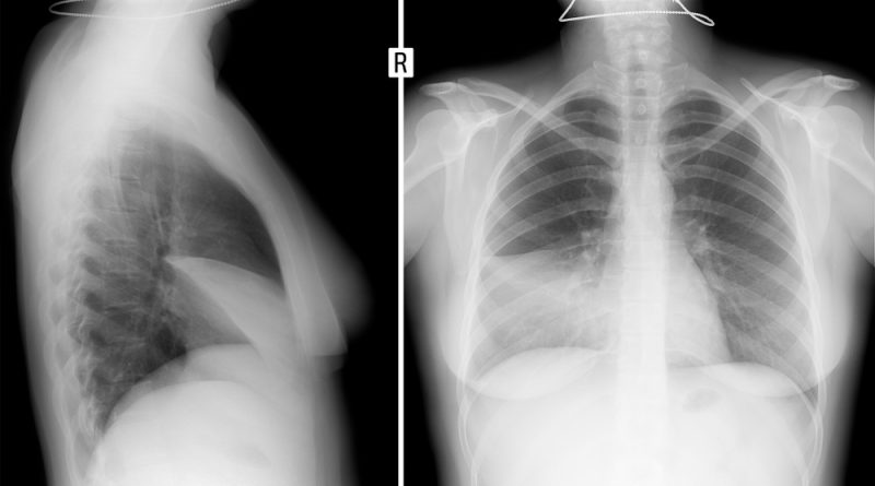 Pleurisy Diagnosis